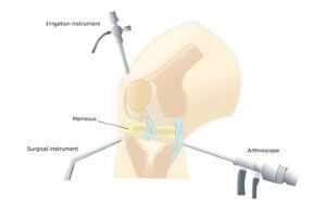 Arthroskopie Gelenkspiegelung Köln